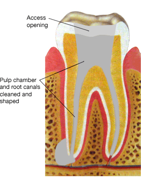 diagram of a root canal