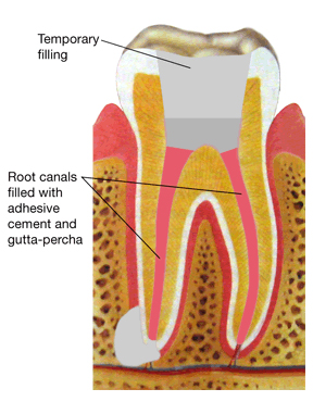 diagram of a root canal