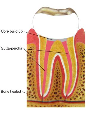 diagram of a root canal