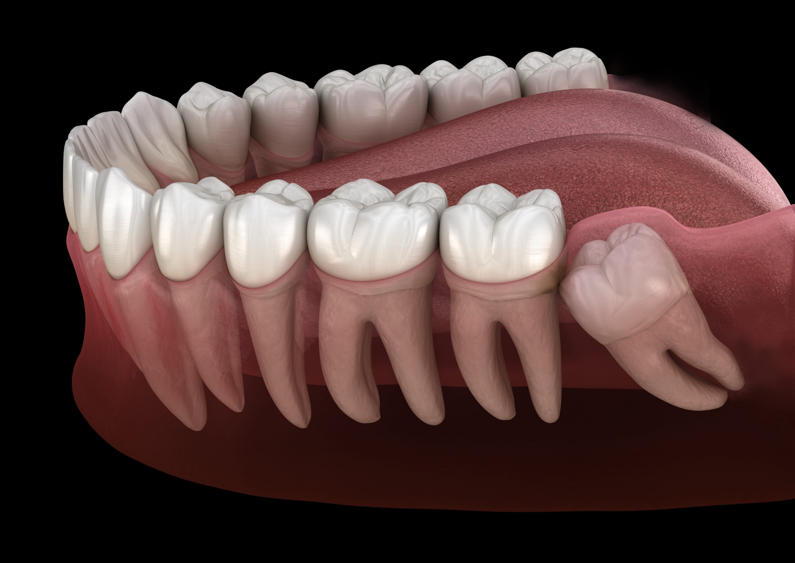 Healthy teeth and wisdom tooth with mesial impaction . Medically accurate tooth 3D illustration